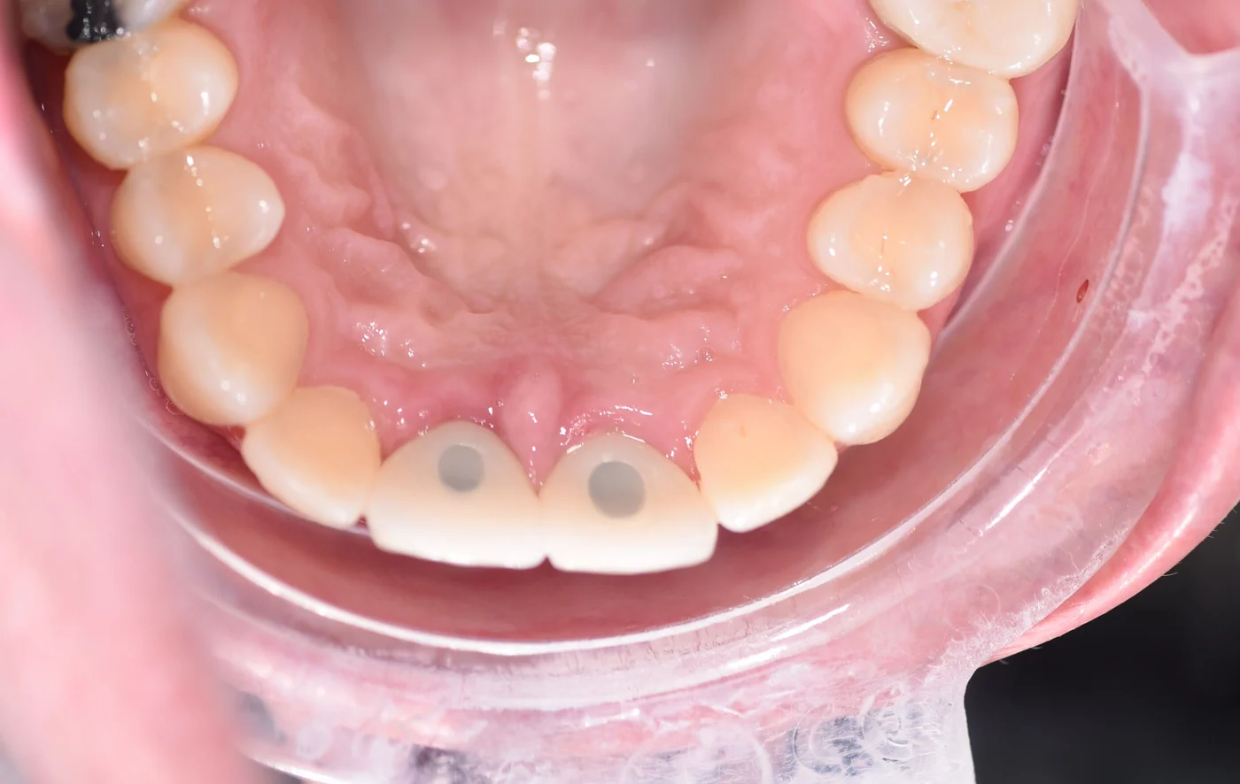 Upper teeth photographed from above, with two front crowns showing open screw-access holes before those holes are sealed