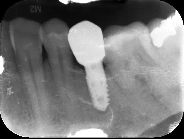 Benefits of bone grafting for dental implant treatment