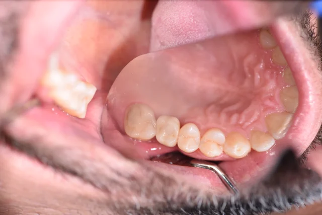 upper back tooth: after crown fitting
