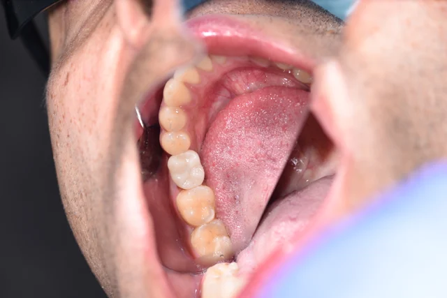 After: A tooth-coloured implant crown occupies the same space. Its chewing surface is visible alongside the neighbouring teeth.