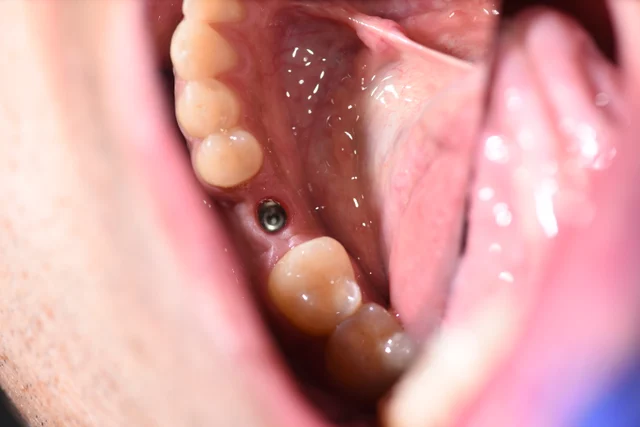 Before: The implant site has no crown, leaving a space between the smaller tooth in front and the larger back tooth behind it.