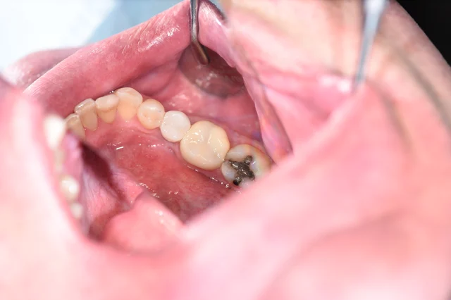 After: An implant crown fills the previously open position. The existing molars, including the dark-filled tooth, remain visible behind it.