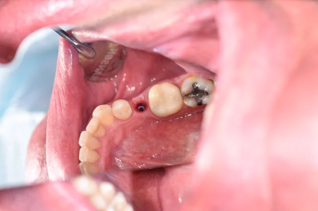 Before: An implant component is visible in the gap ahead of the larger molar. The back molar with its existing dark filling remains in view.