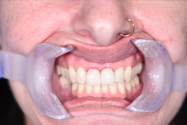 After: Tooth-coloured replacements fill the two front-tooth positions. The same surrounding teeth and lower arch are visible for comparison.