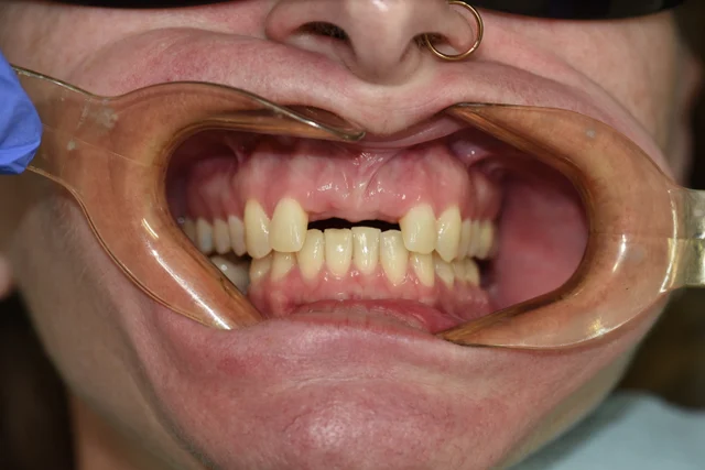 Before: A gap spans the two upper central front-tooth positions, with the gum ridge visible above it. The surrounding teeth remain in view.