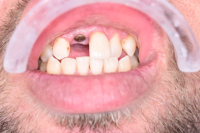 upper front tooth: before final crown