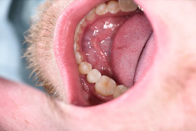 After: A tooth-coloured implant crown occupies the former gap, between the existing teeth and restorations.