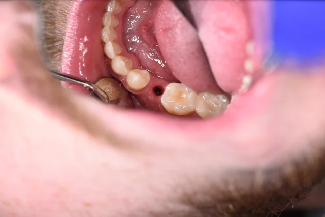 Before: The open tooth position contains an implant site without a crown. A gold-coloured restoration on a neighbouring tooth helps locate the same area in both views.
