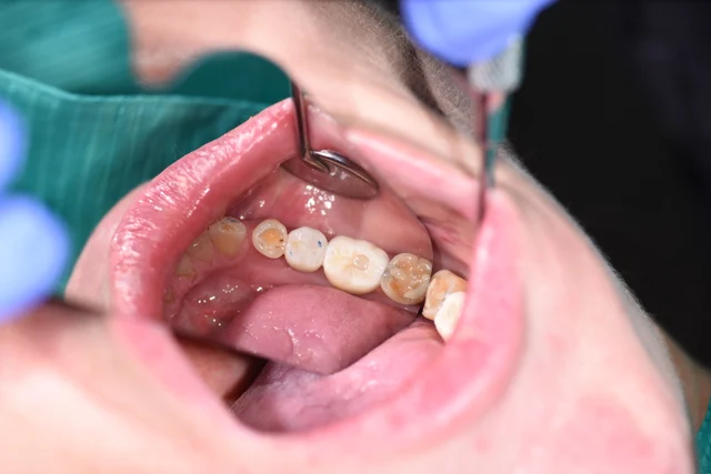 After: A tooth-coloured implant crown fills the gap. Its chewing surface is visible between the same neighbouring teeth.