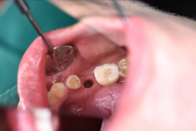 Before: A dark implant component is visible within the single gap, with both neighbouring teeth present.