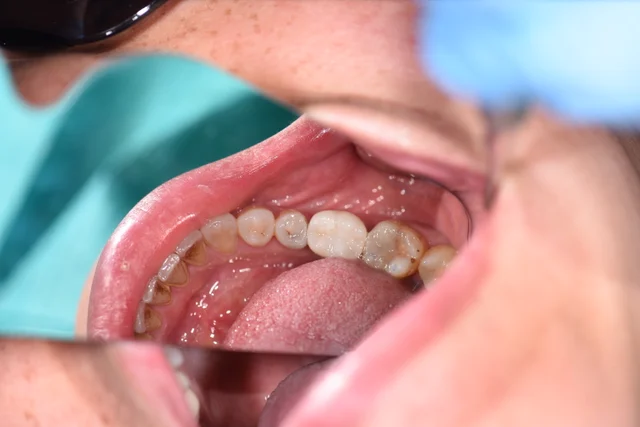 After: A tooth-coloured restoration spans the previously open area, adding chewing surfaces between the remaining teeth.
