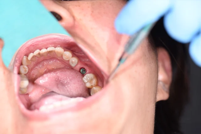 Before: An implant component is visible within the upper back-tooth gap. The open area extends towards the smaller tooth in front of it.