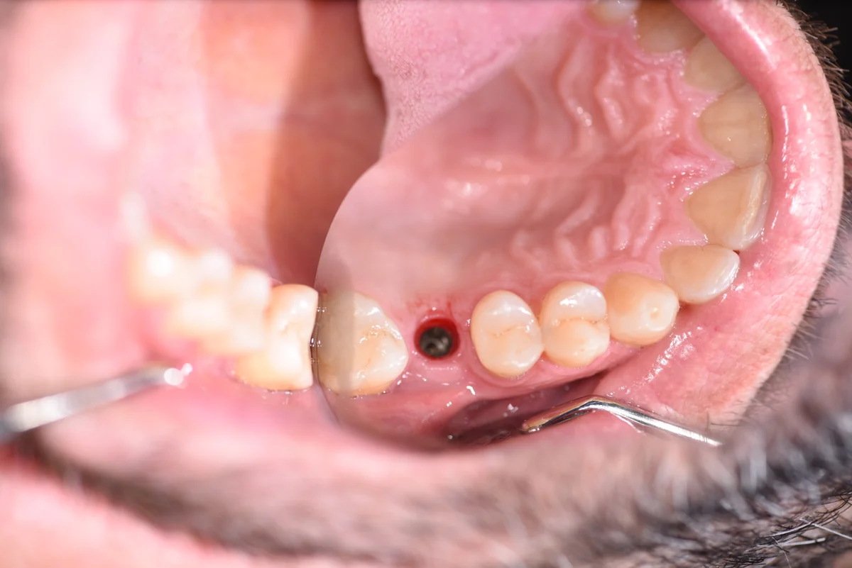 Upper posterior implant site before fitting the final crown