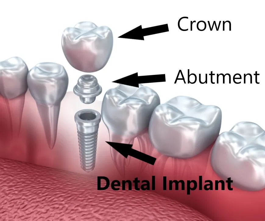 Exploded view of a dental implant showing the fixture in bone, the abutment connector and the crown