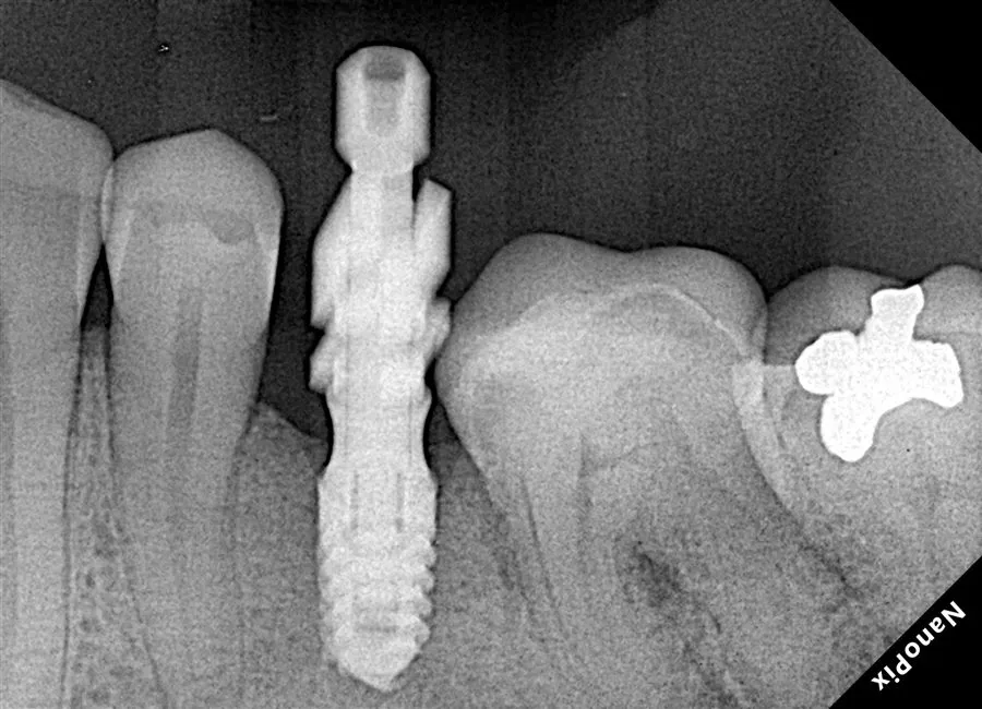 Dental implant suitability assessment x-ray