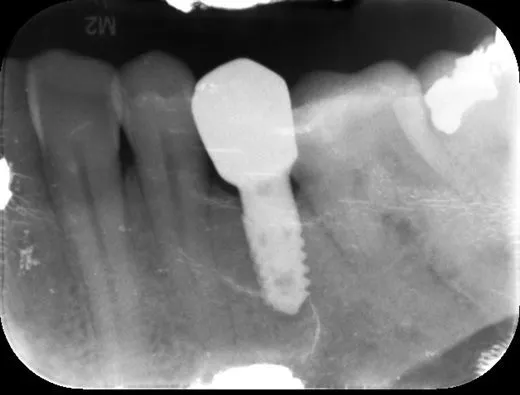 Dental implant x-ray example showing bone assessment