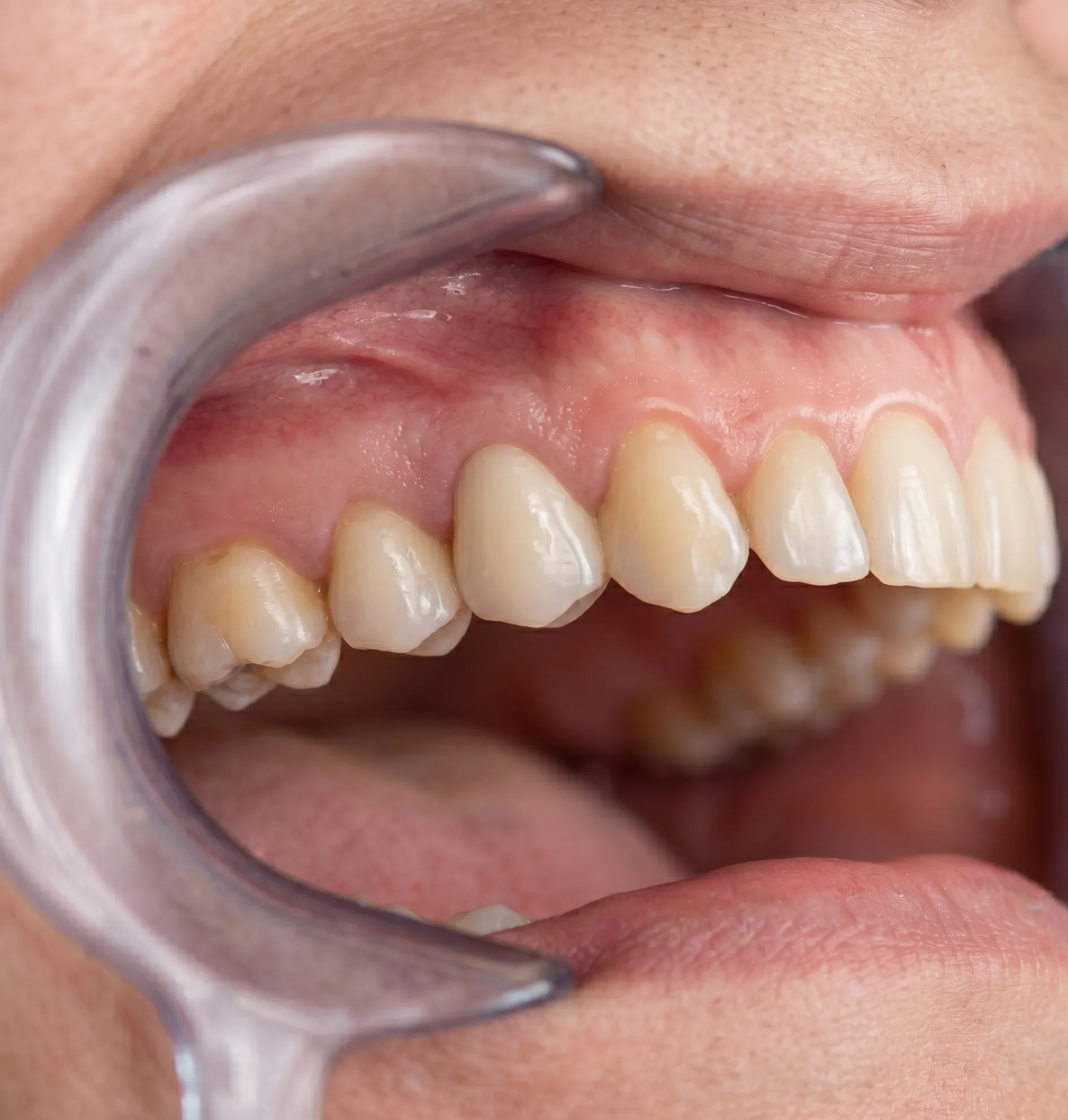 Dental bridges