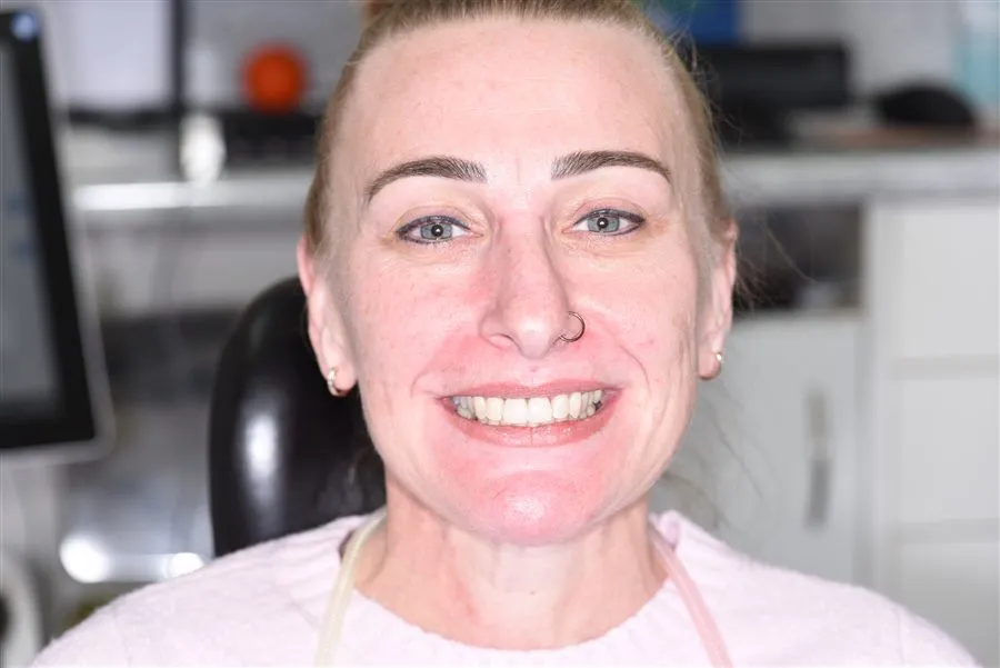 Dentures