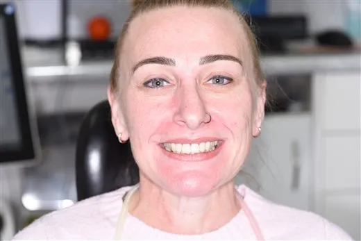 After dental implant Brisbane smile transformation