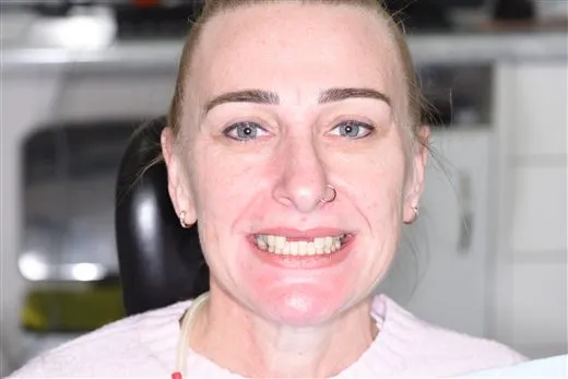 Patient 1 smile before implant treatment