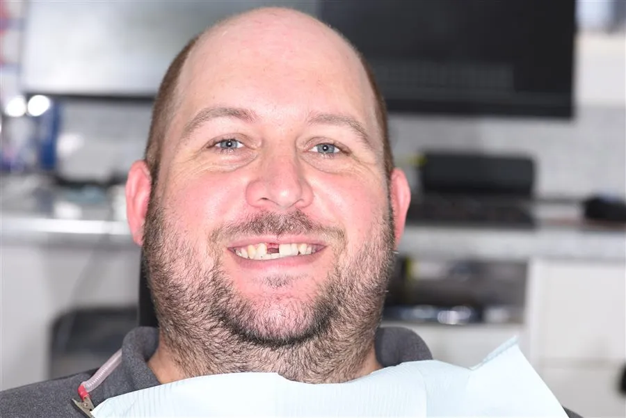 Full smile rehabilitation example after treatment