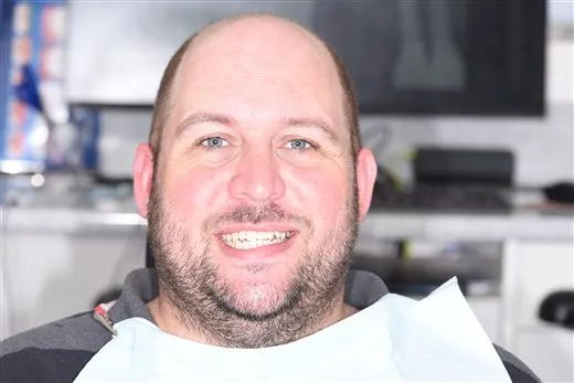 Patient 2 smile after implant treatment